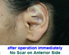 plastic-surgery-prominent-ear 